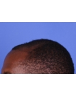 Before Hair Transplant&nbsp;Front